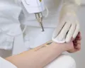 Sudah Tobat, Hapus Tato di Tubuh Hukumnya Tak Wajib, Begini Penjelasannya